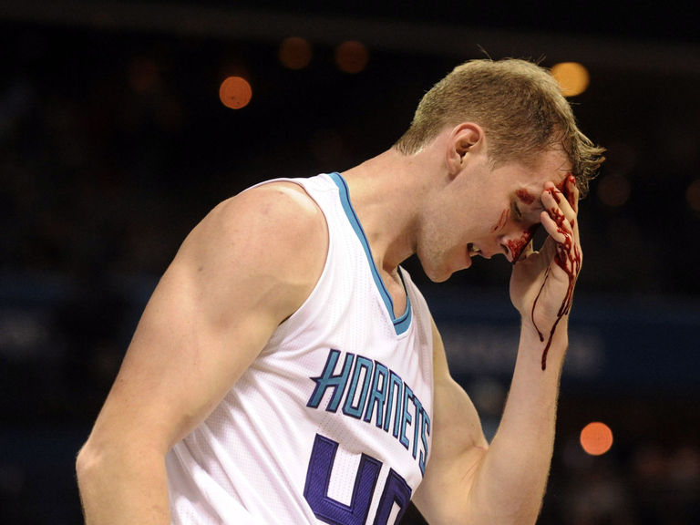 Cody Zeller gets 8 stitches to face after elbow from Noah