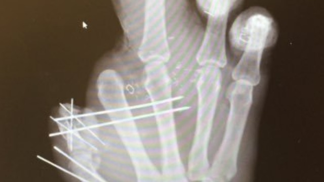 Pierre-Paul shares X-ray of injured hand