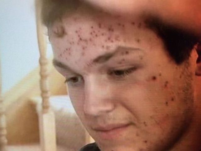 High school wrestler says he got herpes from wrestling mat
