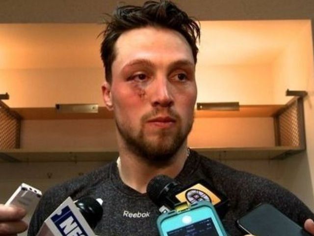 Bruins' Beleskey lucky to have 'just another black eye'