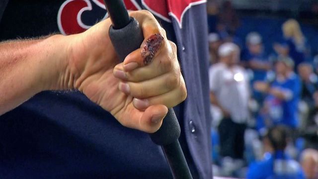 Bauer's bloody finger is worse than you think