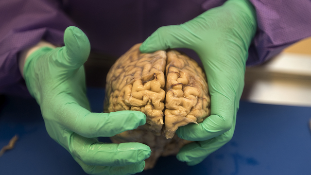 BU study takes 'early steps' toward diagnosing CTE in living patients